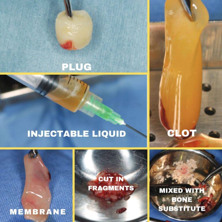 Clinical application of Platelet Rich Fibrin in dental implantology.
